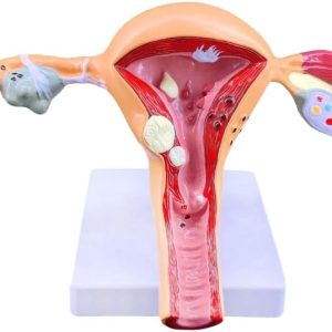 Modelo anatómico de patología de ovario de útero